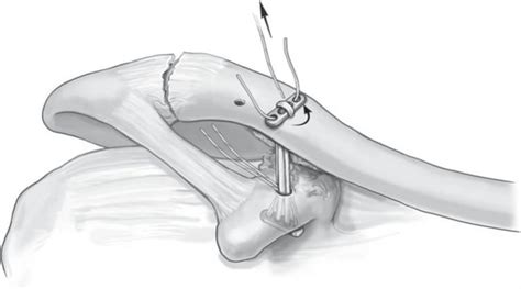 Double Endobutton Technique For Repair Of Complete Acromioclavicular