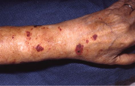 Causes Of Senile Purpura Information And Symptoms Of Senile Bleeding