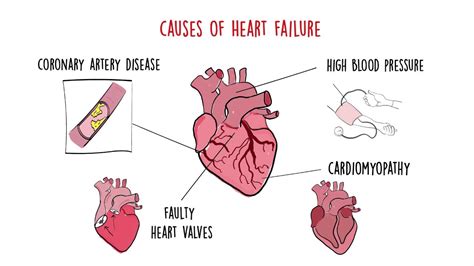 Congestive Heart Failure Symptoms Causes Types Treatment And Prevention