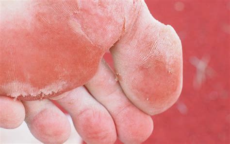 Athletes Foot Causes Symptoms And Treatment