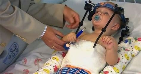 Doctors Reattach Toddlers Head