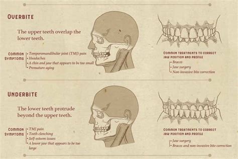Malocclusion Types Symptoms And Causes