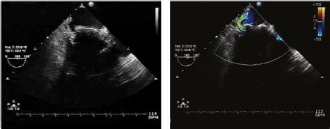 Transoesophageal Echocardiogram Shows The Starr Edwards Mitral Valve