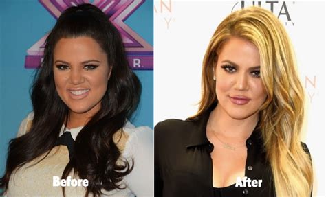 Khloe Kardashian Before and After Plastic Surgery Butt Lift Botox
