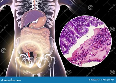 Acute Suppurative Appendicitis Illustration And Light Micrograph Stock