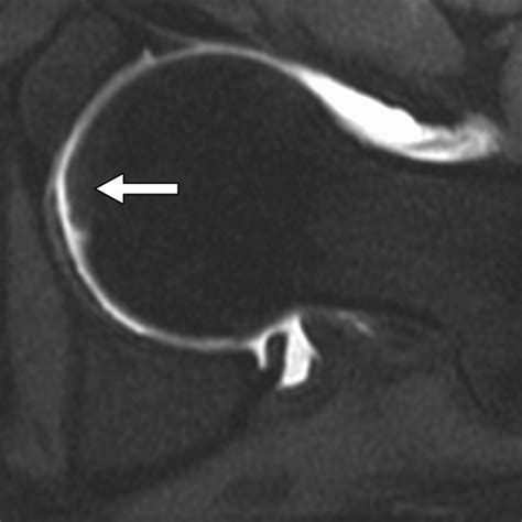Imaging Appearance Of The Normal And Partially Torn Ligamentum Teres On