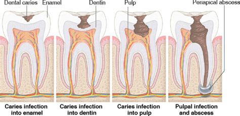 Figure 8 Important Changes Associated With Dental Caries Progression