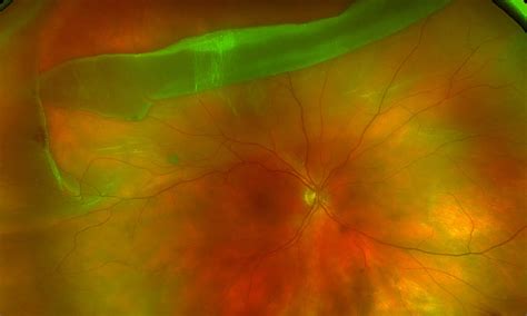 Retinal Detachments For Long Beach Ca Apex Retina Institute
