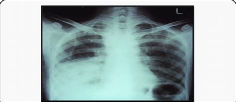 Chest X Ray Showing Right Lower Lobeconsolidation With Right