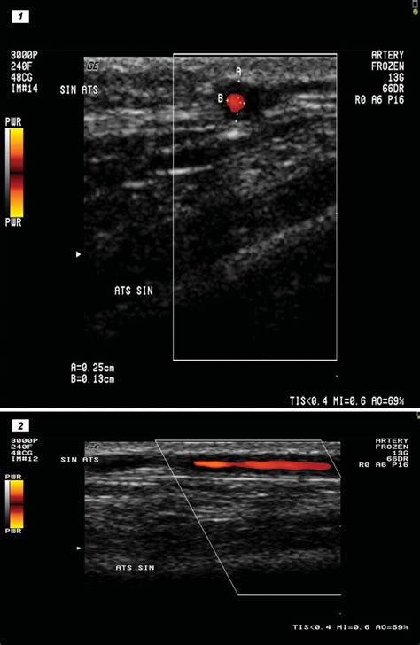 Ultrasound Picture Of Halo Sign In The Superfi Cial Temporal Artery