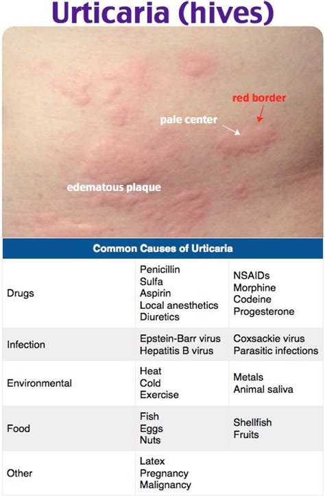 Urticaria Urticariawhealshives Ige Mediated Reaction To Allergen Transient Blanching