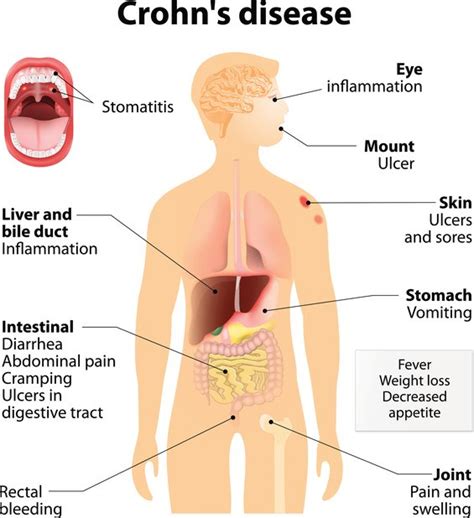 Dietary Treatment Of Crohns Disease A Review Of The Evidence