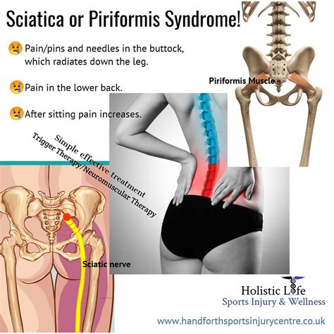 Sciatica Or Piriformis Syndrome