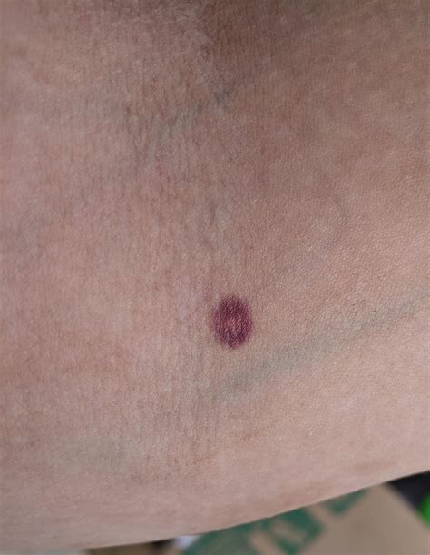 A Weirdly Cheerio Shaped Bruise On My Arm Rmildlyinteresting
