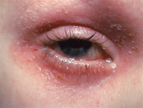 What Causes Contact Dermais Around Eyes Tutor Suhu