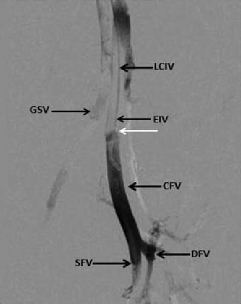 Thrombus Appearing As A Filling Defect In The Iliofemoral Vein
