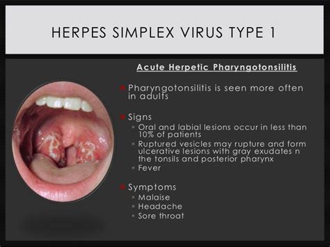 Genital Herpes Simplex Type 1 Genital Herpes Simplex 1 Virus On Finger