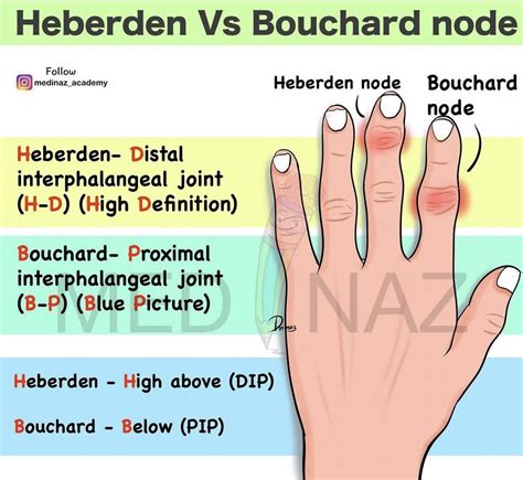 Osteoarthritis Nodes Heberden Bouchard Nodes