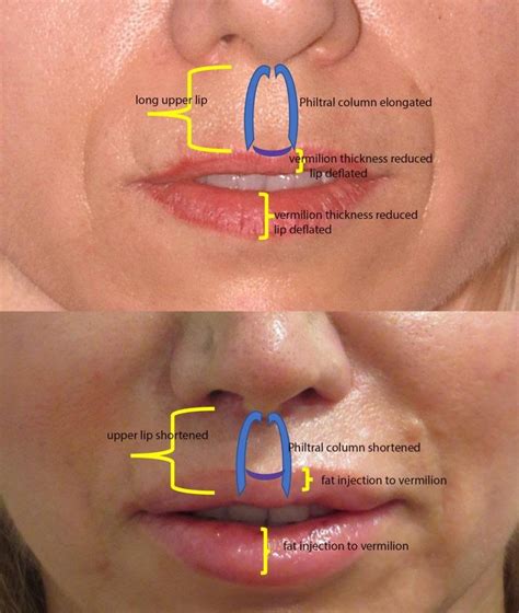 Upper Lip Shortening And Lip Rejuvenation Kirwan Plastic Surgery