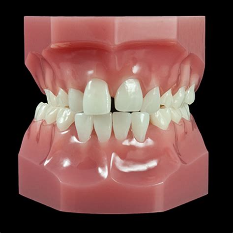Or 17q Mixed Dentitionclass Ii Posterior Crossbite Flexibase
