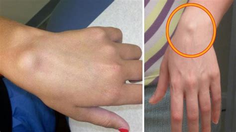 A Man Found A Strange Lump On His Palm And It Turned Out To Be