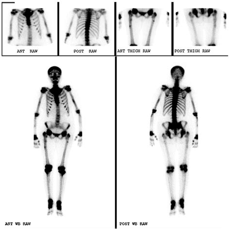 Whole Body Bone Scintigraphy Download Scientific Diagram