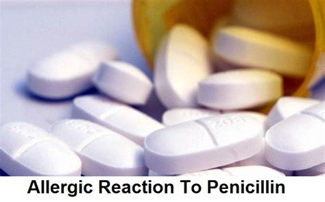 Allergic Reaction To Penicillin Symptoms And Treatment Health And