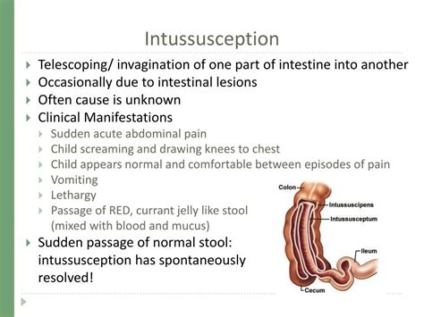 Intussusceptionwhat You Need To Know