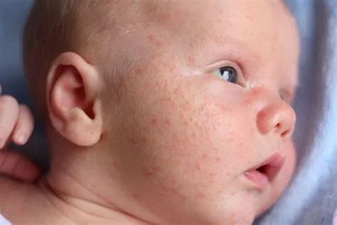 Home Remedies For Heat Rash In Babies