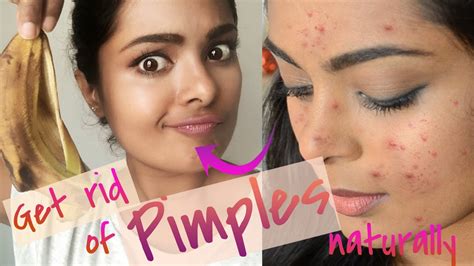 video how to get rid of pimples overnight really works treat acne at home naturally cheap