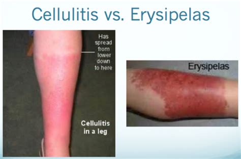Erysipelas Vs Cellulitis Vs Impetigo