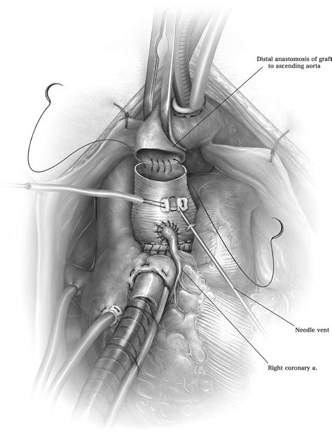 The Button Bentall Procedure Operative Techniques In Thoracic And