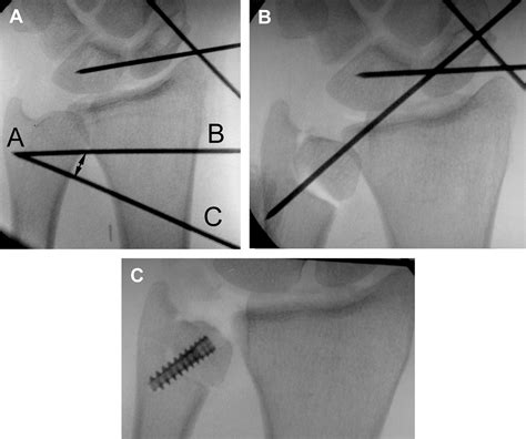 Arthroscopic Management Of Ulnocarpal Impaction Syndrome And Ulnar