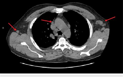 Ct Scan Of The Chest Showing Enlarged Mediastinal And Axillary Lymph