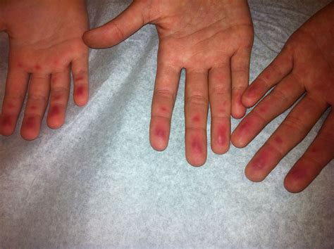 Mysterious Finger Rash Solved Rash On Hands Red Rash Rashes