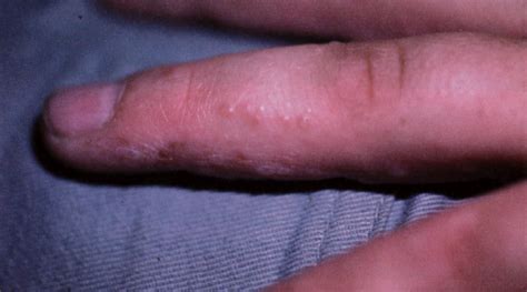 11 Year Old Boy With Itchy Bumps On Sides Of Fingers The Doctors