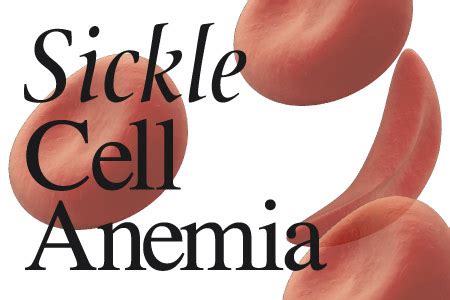 Sickle cell anemia is an inherited blood disorder that's characterized by both a deficiency of healthy red blood cells and painful episodes called sickle cell crises. Sickle Cell Anemia Causes, Symptoms, Diagnosis and ...