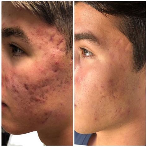 Before And After Hydrafacial Berman Skin Institute