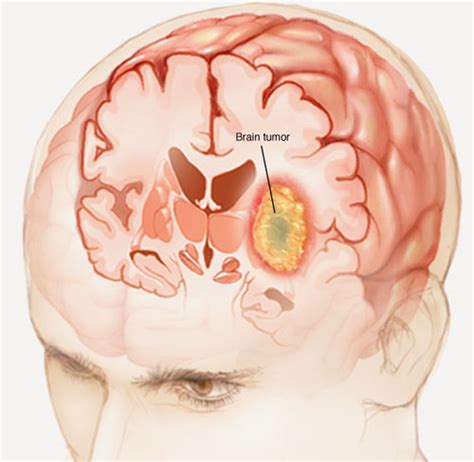 Brain Tumor Surgeon In Gurgaon Archives Brain And Spine Neuro Center Blog