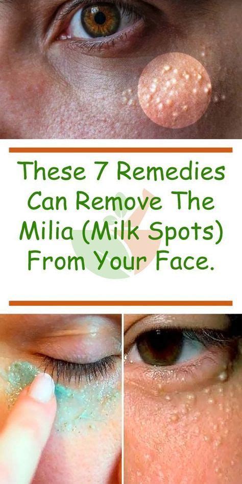 How To Get Rid Of Those Little Oil Bumps On The Face Get