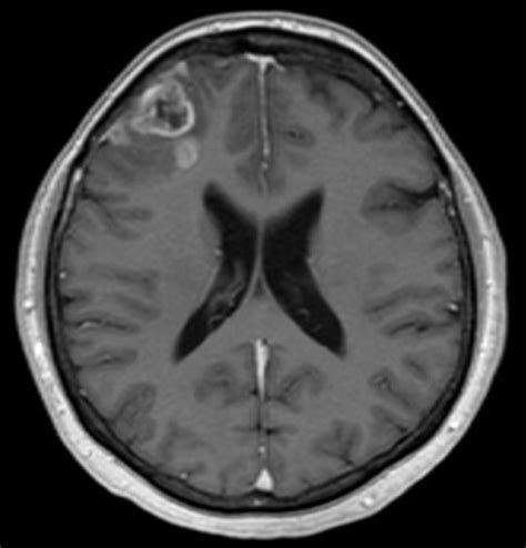 Radiology Imaging Techniques Of Brain Tumours Intechopen