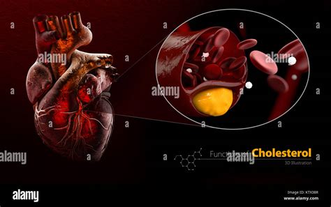 Heart As Example Blocked Blood Vessel Artery With Cholesterol Buildup