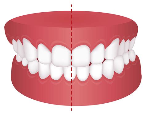 What Is A Crossbite Symptoms And Treatment Options Elara Orthodontics
