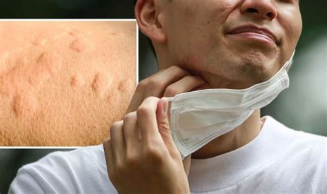 Coronavirus New Strain Symptoms Rashes Chilblains And Hives Are Signs
