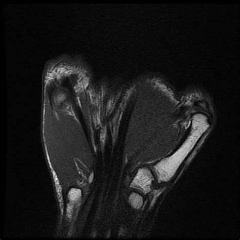 Ganglion Cyst Flexor Tendon Sheath A1 Pulley Image