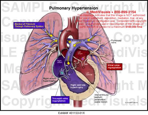 Medivisuals Pulmonary Hypertension Medical Illustration