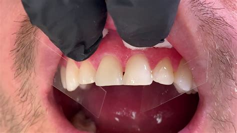 Houston Cosmetic Dentisthow To Bond 4 Minimal Prep Upper Porcelain