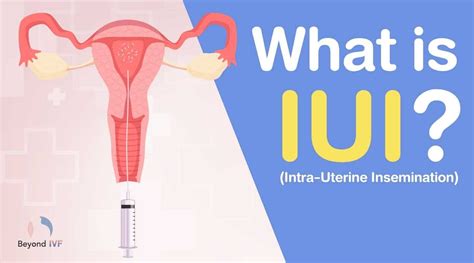 What Is Iui Procedures Success Rates And Costs