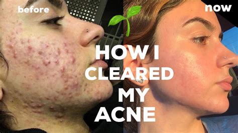 How I Cleared My Cystic Acne Naturally Tips Youtube