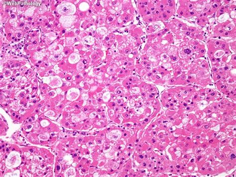 The Who Describes Several Hcc Histologic Patterns Including Trabecular
